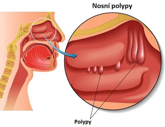Polypy v nose – příznaky, příčiny a léčba