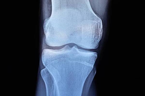 osteoidní osteom, benigní kostní nádor.
rtg a mri, mrt, ct s výraznou sklerózou v okolí ložiska. koncept lékařské léčby. diagnostika onemocnění lidských kostí. - nárt - stock snímky, obrázky a fotky