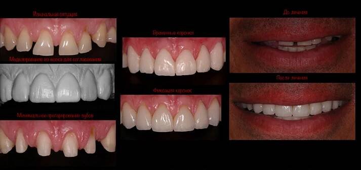 Zubní protézy: druhy, ceny, fotka | City Dental