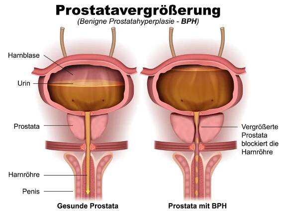 Bildliche Darstellung einer Prostatavergrößerung