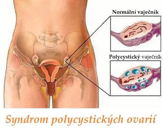 syndrom polycystickych ovarii pcos priznaky projevy symptomy PRPR