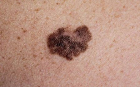 Jak poznat melanom - Příznaky a diagnostické metody melanomu