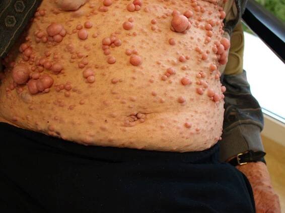 Neurofibromatóza