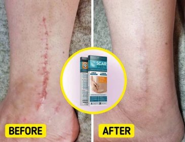 8 Amazon Products That Will Help Reduce the Appearance of Your Scars / Bright Side