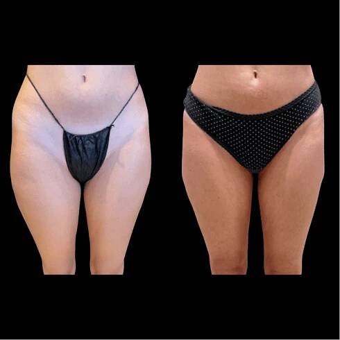 nps_before-after-thighs
