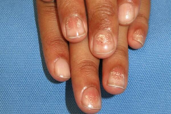 Alopecia areata nehty: obrázky, symptomy a léčba