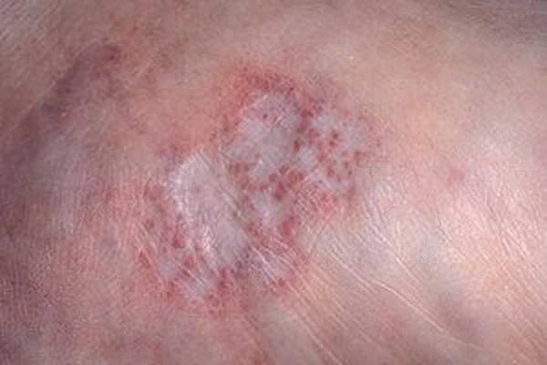 Chronická borelióza / Borrelióza | Užitečné informace a tipy na péči o sebe. Zdraví, výživa a další.