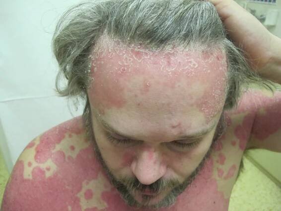 Biologická léčba Lupénky - PSORIÁZY
