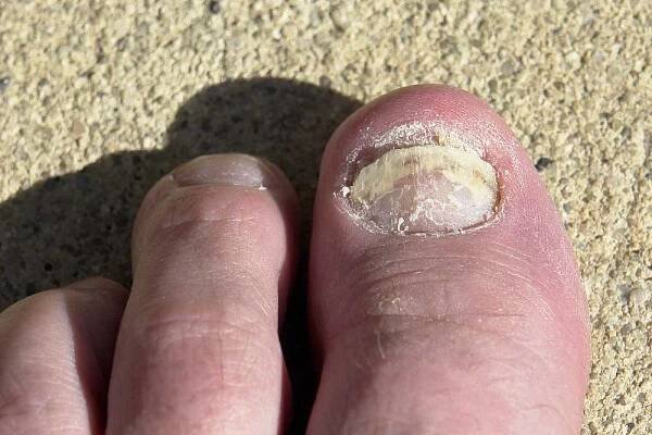 Na nechutné nehty se už nebudete muset dívat: S touto babskou fintou zmizí plíseň dřív, než řeknete švec. Budou krásné už za 7 dní