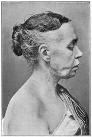 Soubor:An introduction to dermatology (1905) Mycosis Fungoides (Jamieson's case) October 1902.jpg