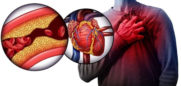 Ischemická choroba srdečníAngina pectoris - Kardiologická ambulance