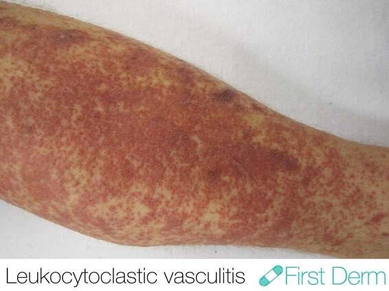 Vasculitis (Leukocytoclastic Vasculitis) - Online Dermatology