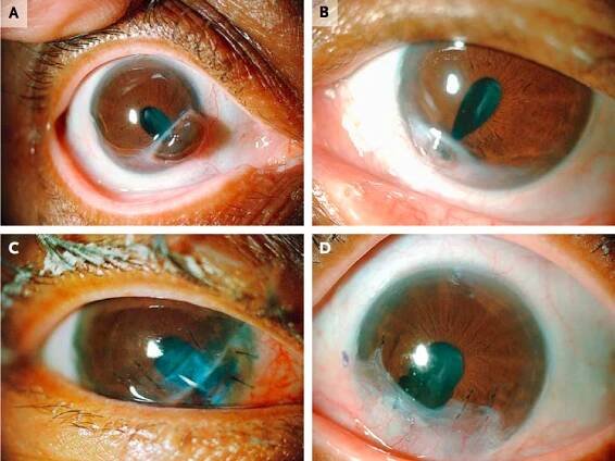 'Corneal Melt': Arthritis Complication Lets Woman's Iris Slip Out