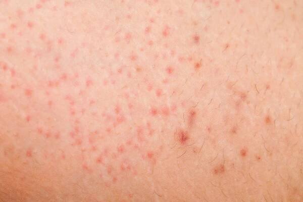 Laser hair removal for professional include the treatment of disorder hair follicle