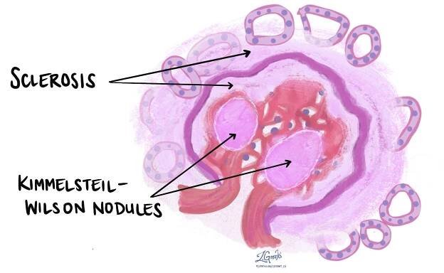 Diabetic nephropathy (diabetic glomerulosclerosis) | MyPathologyReport