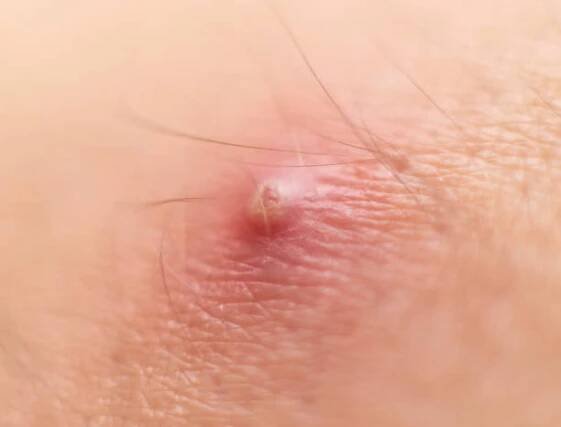 velký červený vroucí pupínek furuncle na kůži, makro, zanícené vaření, dermatologie - absces trauma - stock snímky, obrázky a fotky