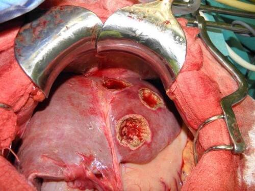 Chirurgie jaterních metastáz :: CHIRURGICKÁ KLINIKA 