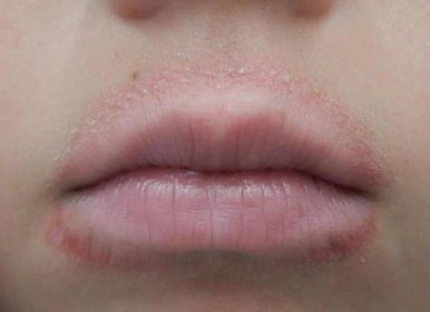 dermatitida kolem úst