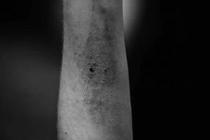 Ran a poškozené pokožky na lidské ruce — Stock obrázek