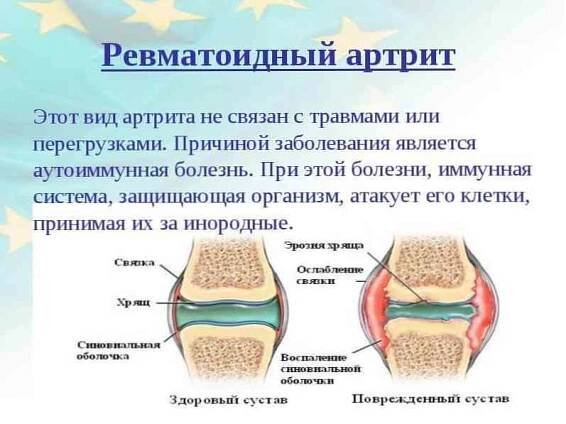 Symptomy revmatoidní artritidy, léčba a diagnóza / Reumatologie | Užitečné informace a tipy na péči o sebe. Zdraví, výživa