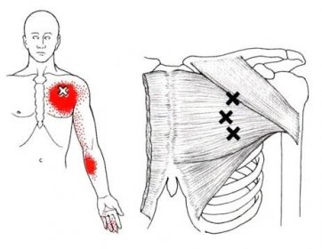 Bolest na přední straně zápěstí a dlaně - příčiny - Spoušťovýbod