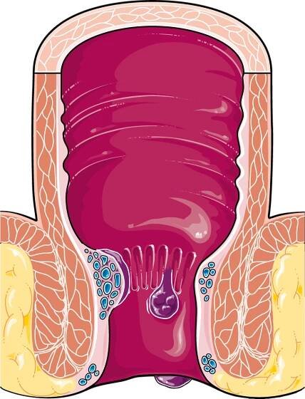 hémorrhoides
