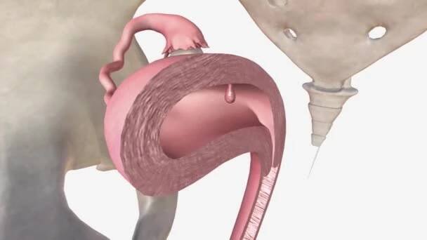 Endometriální polyp nebo děložní polyp je abnormální růst obsahující žlázy, stroma a cévy vyčnívající z sliznice dělohy (endometrium), která zabírá prostory dostatečně malé nebo velké k vyplnění děložní dutiny. — Stock záběr