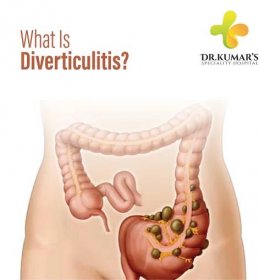 WHAT IS DIVERTICULITIS? - Dr.Kumar's Hospital