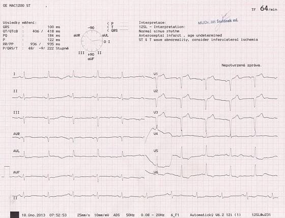 EKG z praxe 27 | Medicína, nemoci, studium na 1. LF UK