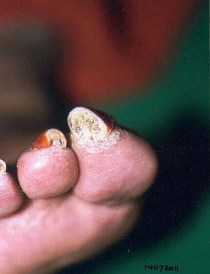 gangrene_3rd_patient