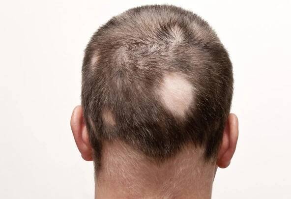 alopecia-areata