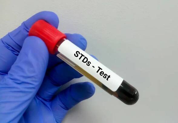 vzorek krve pro pohlavně přenosné choroby (sexuálně přenosné nemoci) test - chlamydie - stock snímky, obrázky a fotky