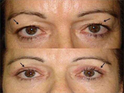A beesett szemek nem nyújtanak túl szép látványt. Ezzel a keverékkel megszabadulhatunk a problémától! A csüngő szemhéjak, és a beesett szemek az Plaster Wall Art, Cosmetology, Beauty Health, Anti Aging, Beauty Hacks, Facial, Health, Makeup, Hair