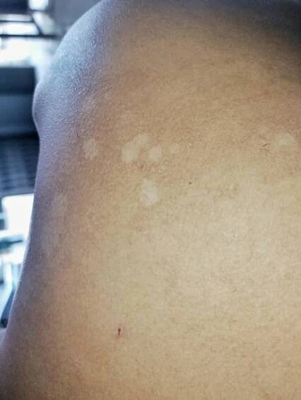 tinea versicolor pityriasis versicolor na kůži - pityriasis - stock snímky, obrázky a fotky