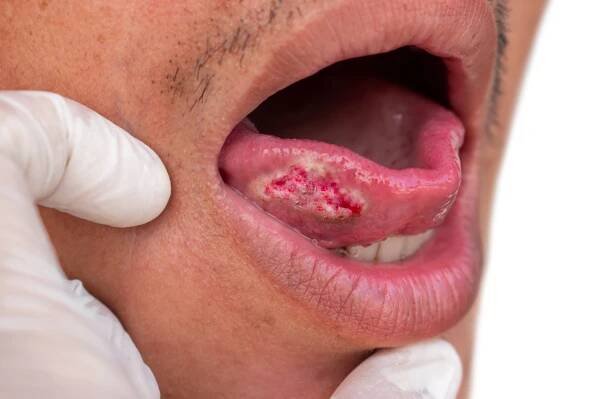 Orální lichen planus v kostce: Jak v praxi na toto multifak...