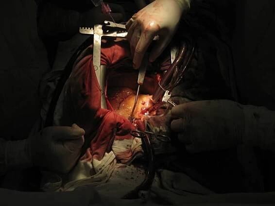 operace bypassu koronární tepny - tracheotomy tubing - stock snímky, obrázky a fotky