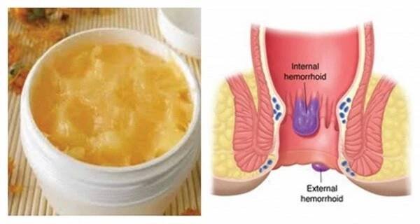 Jak odstranit hemoroidy přírodní cestou - www.Vitalitis.cz