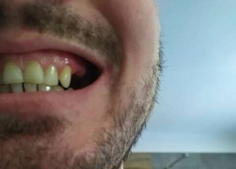 DENTICOR - Nové zuby rychle a levně bez zubaře již od 2000 Kč