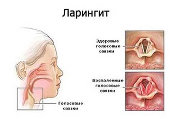 Příčiny, příznaky a léčba laryngitidy / Laryngitida