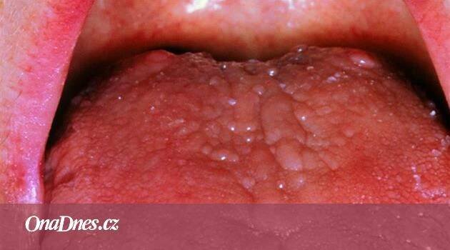 Mám Sjögrenův syndrom. Nemoc, která ničí mé tělo a nejde vyléčit - iDNES.cz