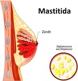 Mastitida je bakteriální infekce prsu, která se obvykle vyskytuje u kojících matek.