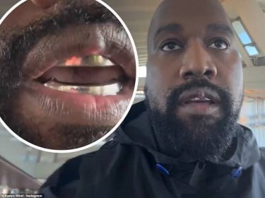 Kanye West sparked some concerns with fans on Monday after he appeared to have a growth on the center of his upper lip, which comes about a month after he had titanium teeth installed. Dailymail.com previously broke the news that West, 46, spent around $850,000 for the experimental dental surgery, but now he has sparked concern with a visible lump on his top lip.
