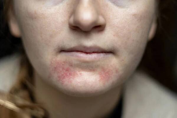 perioral dermatitis on woman face. closeup dermatitis on skin, ill allergic rash eczema skin of patient, atopic dermatitis symptom skin detail texture. the concept dermatology - zlatý stafylokok - stock snímky, obrázky a fotky