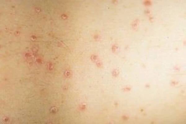 Psoriasis at the initial stage