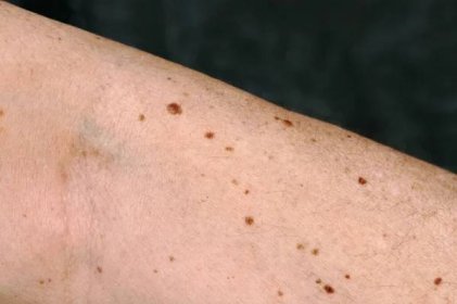 Nebezpečné nebo neškodné pigmentové skvrny na kůži — Stock obrázek