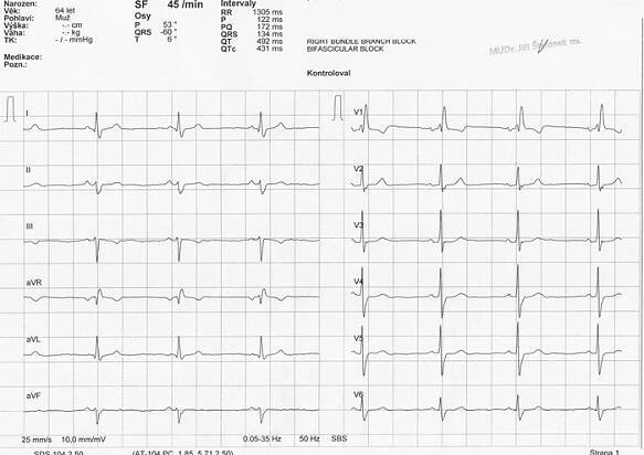 EKG z praxe 18 | Medicína, nemoci, studium na 1. LF UK