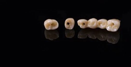 Zubní implantát lidské. Zubní koncept. Keramické lidské zuby nebo zubní protézy. — Stock obrázek