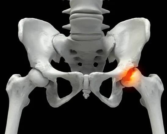 Femur kost postižená Legg-Calve-Perthes nemoc, dětský kyčel porucha, která ovlivňuje přívod krve do femuru hlavy, 3D ilustrace ukazuje postižené levé stehenní kosti (pravá strana obrazu) — Stock obrázek