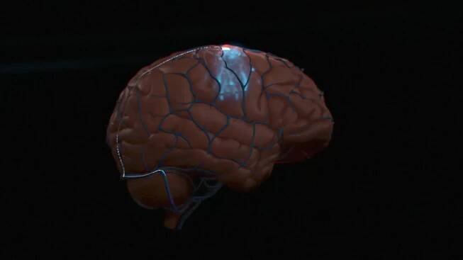 thumbnail Stentrode™ is implanted within the motor cortex of the brain via the jugular vein in an endovascular procedure.