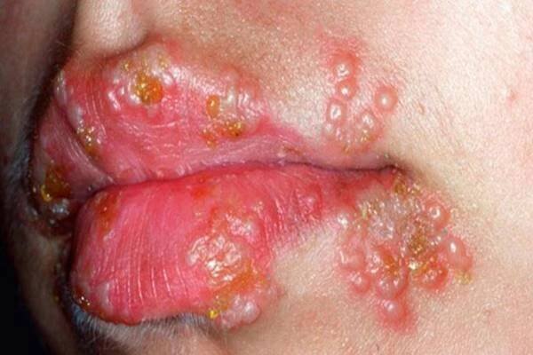 Toto je jediný přírodní lék na herpes, který funguje během několika hodin!